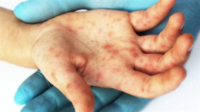 لماذا لا تنفع المضادات الحيوية في علاج مرض اليد والقدم والفم؟