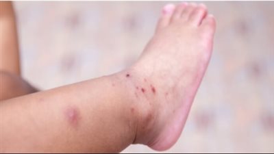 فيروس HFMD: متى يصبح من الضروري مراجعة الطبيب فورًا؟