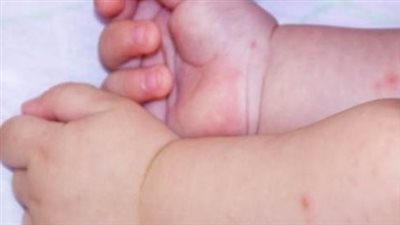 فيروس hfmd حقيقة مرض اليد والقدم والفم: مرض بسيط أم خطر على الأطفال؟