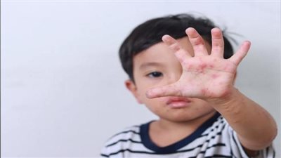 الوقاية من فيروس HFMD: خطوات عملية لحماية طفلك