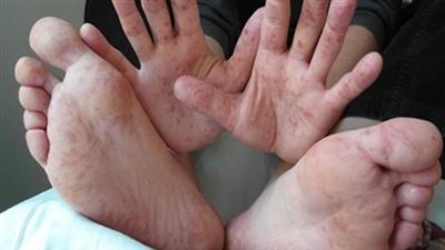 انتشار حالات جديدة من فيروس اليد والقدم والفم… التفاصيل والأعراض