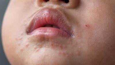 HFMD: مرض فيروسي سريع الانتشار يهدد المدارس والحضانات