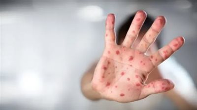 وزارة الصحة تكشف حقيقة إغلاق مدرسة دولية بالجيزة بسبب فيروس hfmd