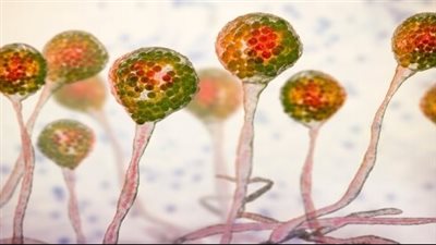 أعراض التعرض للعفن الأسود.. علامات شائعة وأخرى نادرة