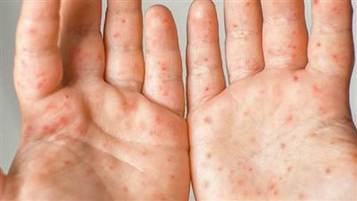 أسباب الإصابة بفيروس HFMD.. وطرق العلاج وأعراضه