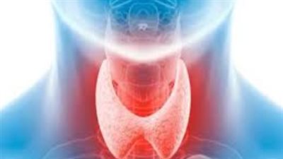 علاج هاشيموتو والسيطرة على أعراضه: خبراء يوضحون