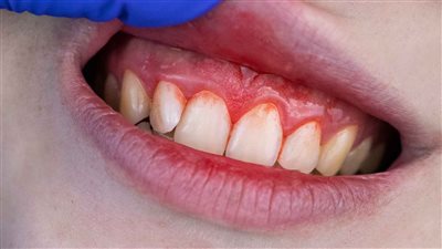علامات أمراض اللثة وأسبابها وطرق الوقاية منها