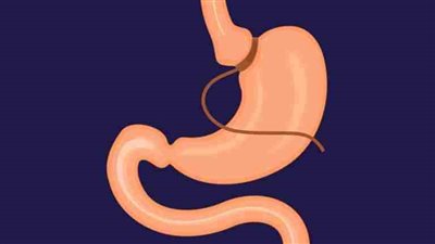 مخاطر جراحات تكميم المعدة 