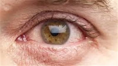 أعراض متلازمة جفاف العين.. 7 علامات يجب الانتباه لها