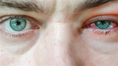 علاج العين الوردية.. طرق مفيدة للتخلص من التهاب الملتحمة