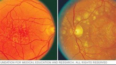 علامات وأعراض الضمور البقعي بالتفصيل