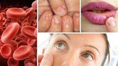 أعراض فقر الدم..  علامات رئيسية انتبه لها