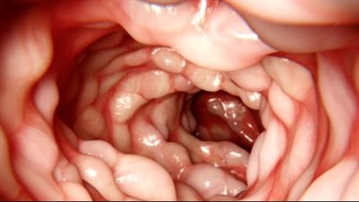 كيفية الوقاية من مرض كرون.. خطوات فعالة لتقليل الأعراض