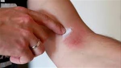 مخاطر استعمال مراهم الكورتيزون على الجلد 