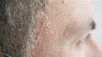 كيفية علاج قشرة الوجه