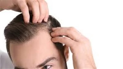 علاج قشرة الرأس في المنزل بـ 6 طرق فعالة