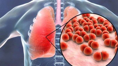الصحة العالمية: مرض السل لا يزال المرض المعدي الأكثر فتكًا في العالم