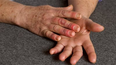 ما يجب أن تعرفه عن مرض رينود