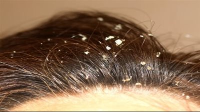 أنواع قشرة الرأس.. الأسباب والعلاج بالتفصيل لكل نوع