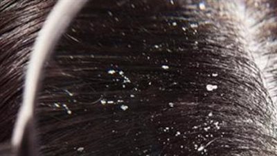 قشرة الرأس.. أنواعها وأسبابها ومحفزات الإصابة بها