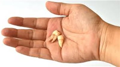 تفسير حلم سقوط الأسنان في اليد دون ألم