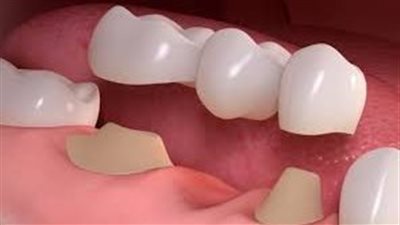 ما هي خطوات تركيب الأسنان؟ 
