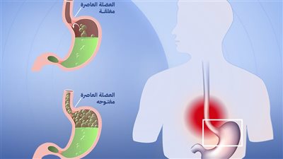 أعراض الارتجاع المعدي المريئي.. مضاعفات خطيرة انتبه لها