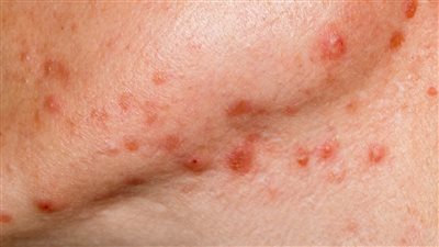 أسباب حب الشباب العقدي.. 8 خطوات للتعامل معه