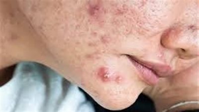 حب الشباب الكيسي.. أسبابه وطرق علاجه