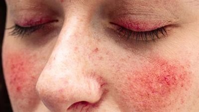 أسباب ظهور بقع حمراء على البشرة.. 7 عوامل مرضية محفزة