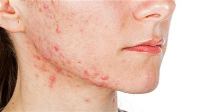 علاج حب الشباب الهرموني.. 10 أساليب فعالة
