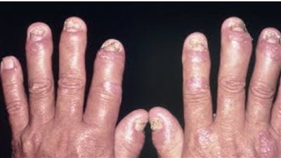 الفرق بين التهاب المفاصل الصدفي والتهاب المفاصل الروماتويدي