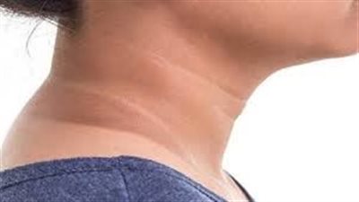 أعراض مقاومة الأنسولين.. 8 علامات رئيسية تعرف عليها