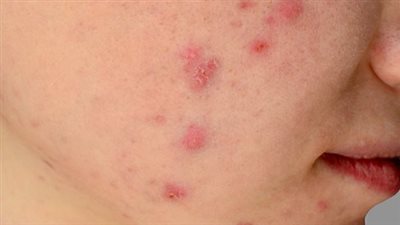 أسباب ظهور حب الشباب الالتهابي وكيفية التعامل معه