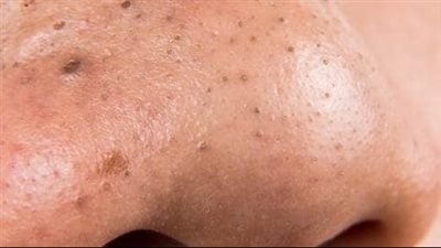 الرؤوس السوداء وكيفية علاجها للتخلص منها نهائيا