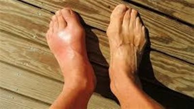 أسباب نوبات النقرس.. 8 عوامل محفظة على الإصابة