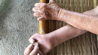 أعراض الجذام.. علامات خطيرة بعضها يؤثر على الأعصاب