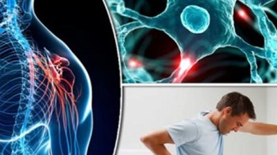 التصلب المتعدد (MS): دليل شامل حول 