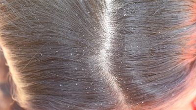 5 أسباب لـ قشرة الرأس وتساقط الشعر تعرفي عليها