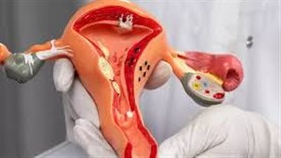 أعراض الانتباذ البطاني الرحمي.. 4 علامات مؤلمة