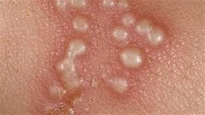 4 أعراض شائعة للهربس النطاق تعرف عليها