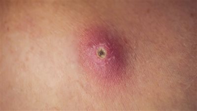 علاج الدمامل.. أساليب منزلية ودوائية للتخلص من الدمل نهائيا