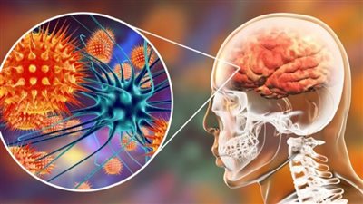 التهاب السحايا العقيم.. تعرف على أسبابه وأعراضه 