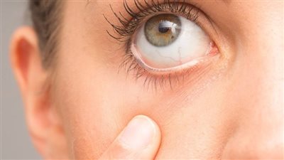 متلازمة جفاف العين.. 10 علامات يجب الانتباه إليها