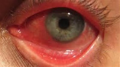 أعراض التهاب الملتحمة.. 5 علامات للعين الوردية