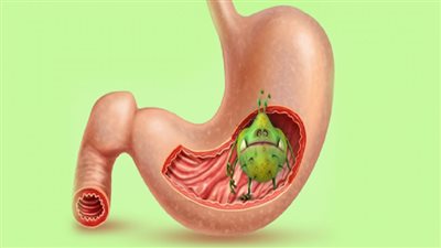 5 أعراض لعدوى جرثومة المعدة يجب الانتباه إليها