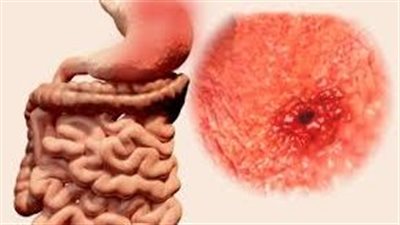ما هو مرض القرحة الهضمية؟.. أسبابها وأعراضها وعلاجاتها