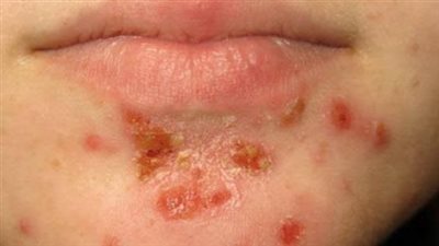 الهربس.. أسبابه وأعراضه وعلاجه الدوائي