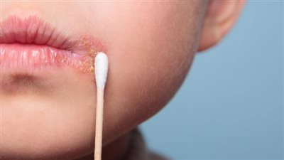 أعراض الهربس.. علامات تدل على الهربس الفموي والتناسلي
