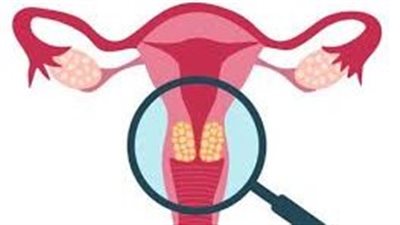 أعراض سرطان عنق الرحم.. 5 علامات رئيسية انتبهي لها